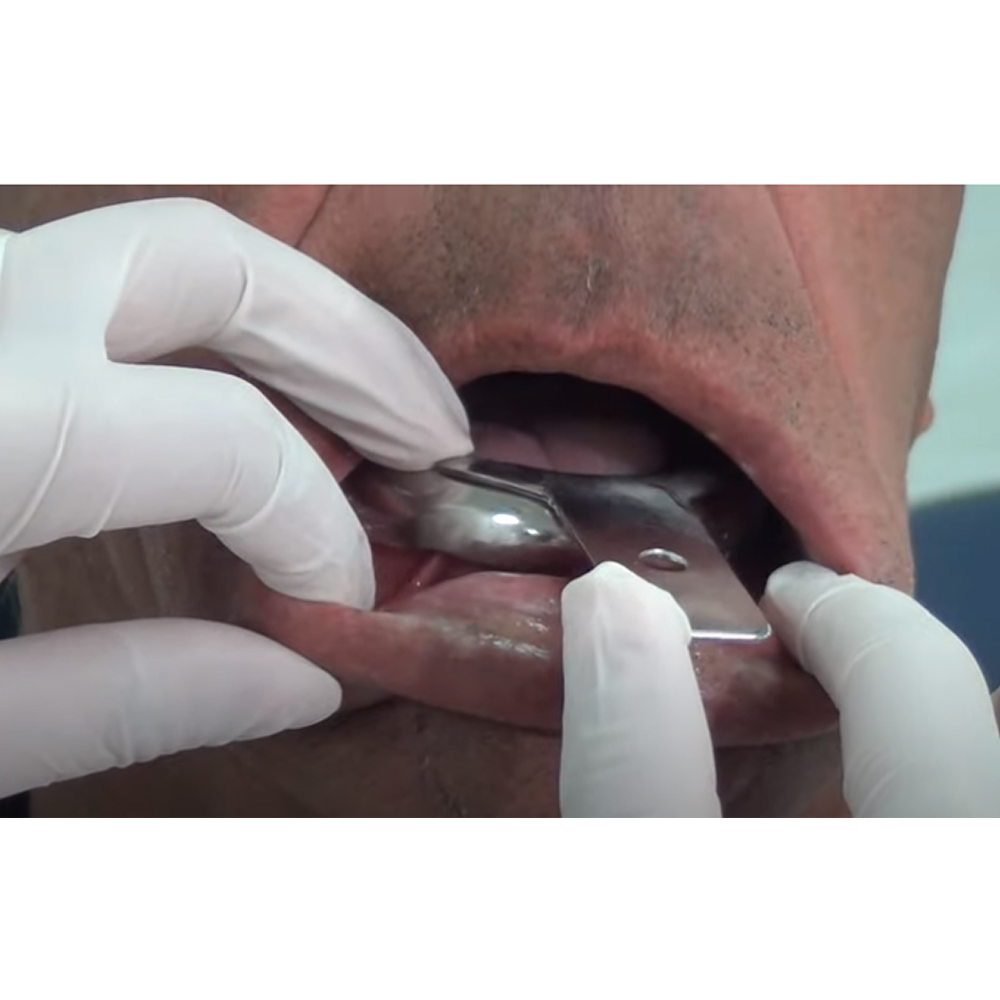 Gdc Impression Trays Edentulous Non-Perforated