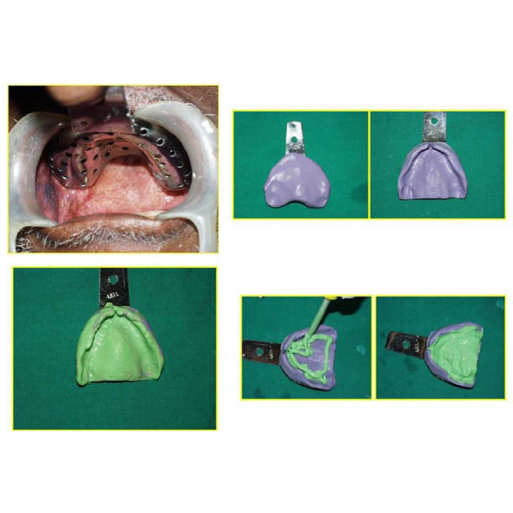 Oracraft Impression Tray Edentulous Perforated Kit Set of 8 - ITRLEDPP8