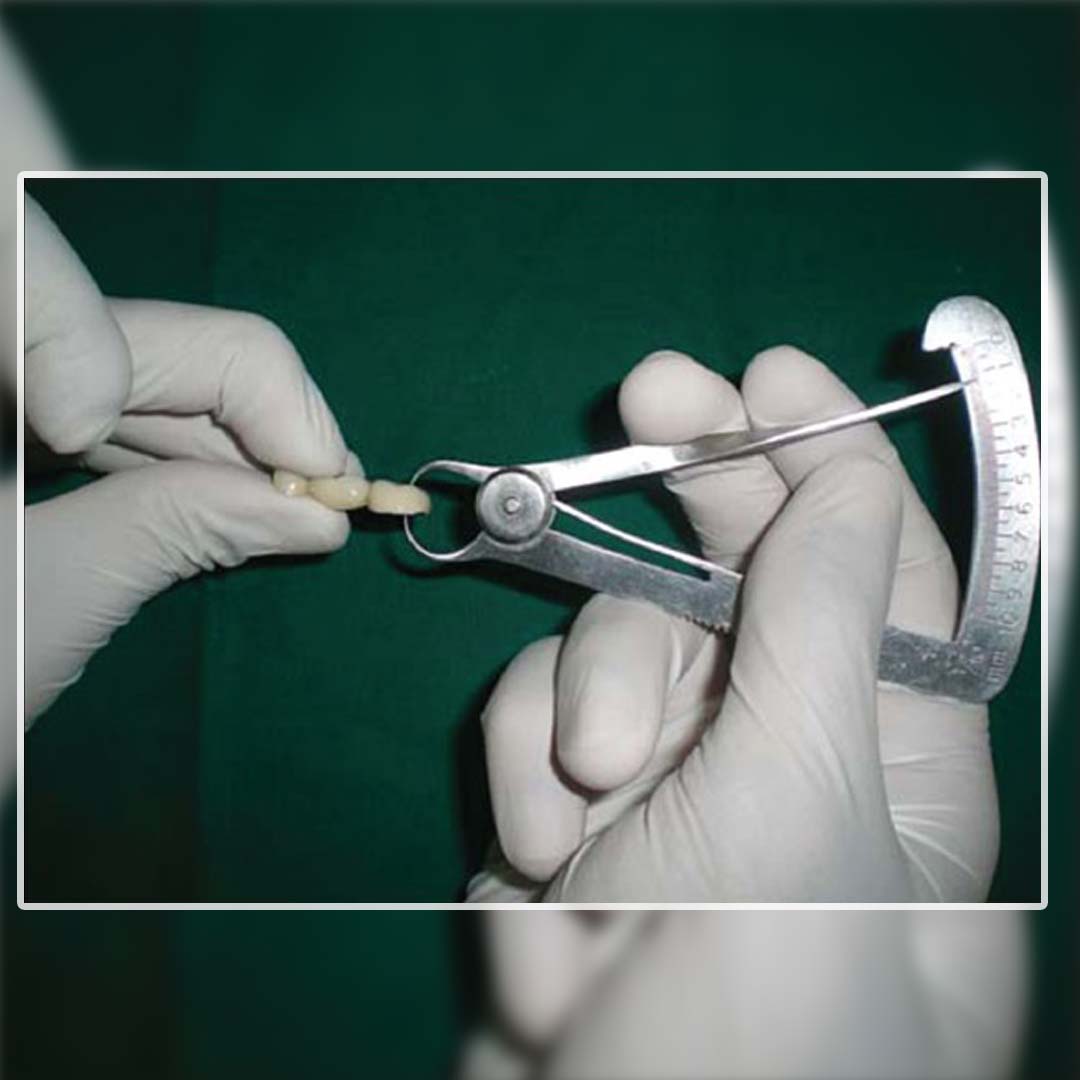 Waldent Iwanson Caliper Metal 0-10mm (60/101)