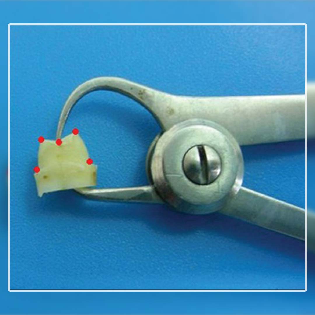 Waldent Iwanson Caliper Metal 0-10mm (60/101)