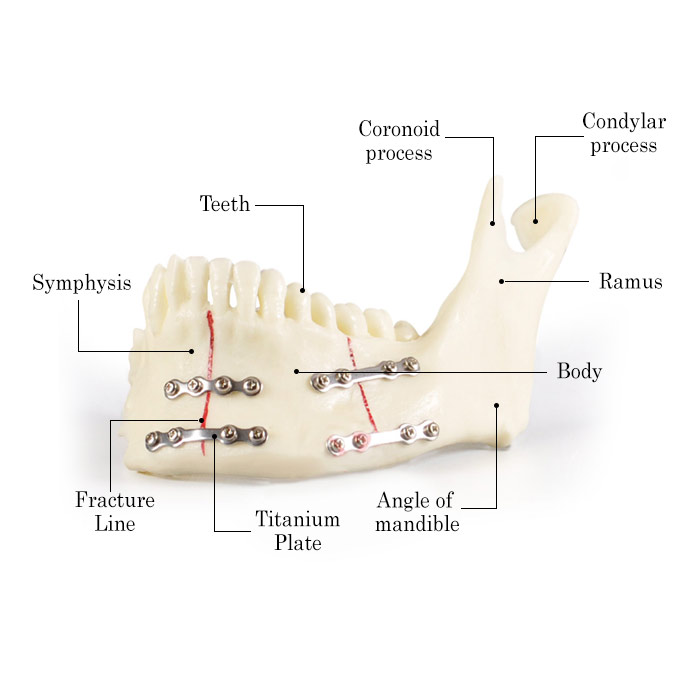 iDENTical Jaw with Titanium Plate Model M5001   