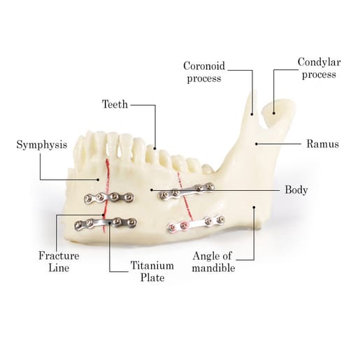 iDENTical Jaw with Titanium Plate Model M5001