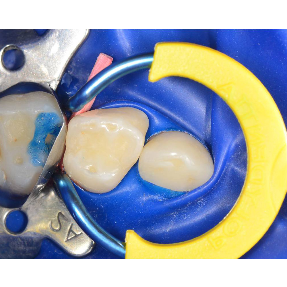 Polydentia myJunior Paediatric Sectional Matrix System Kit & Refills