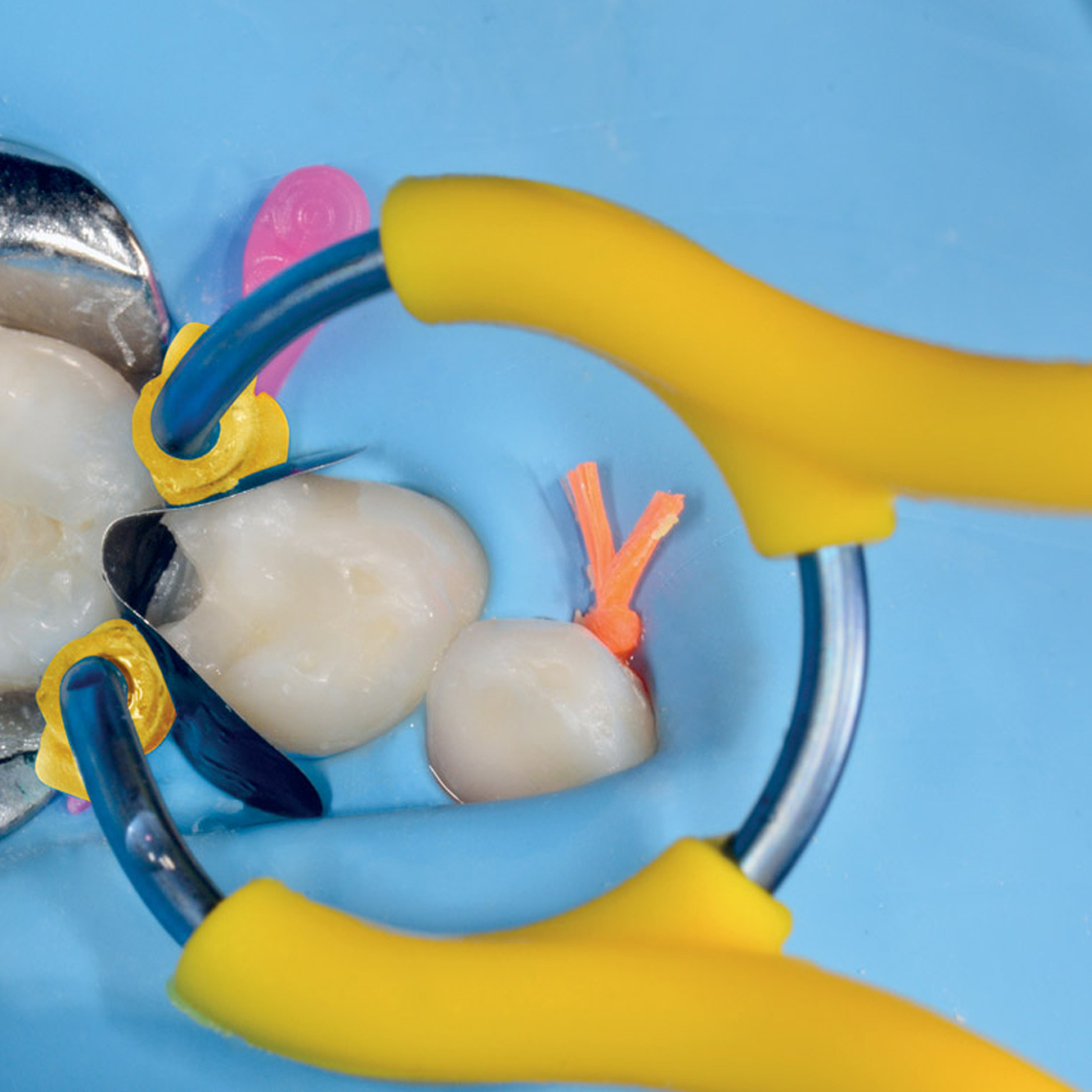 Polydentia myJunior Paediatric Sectional Matrix System Kit & Refills