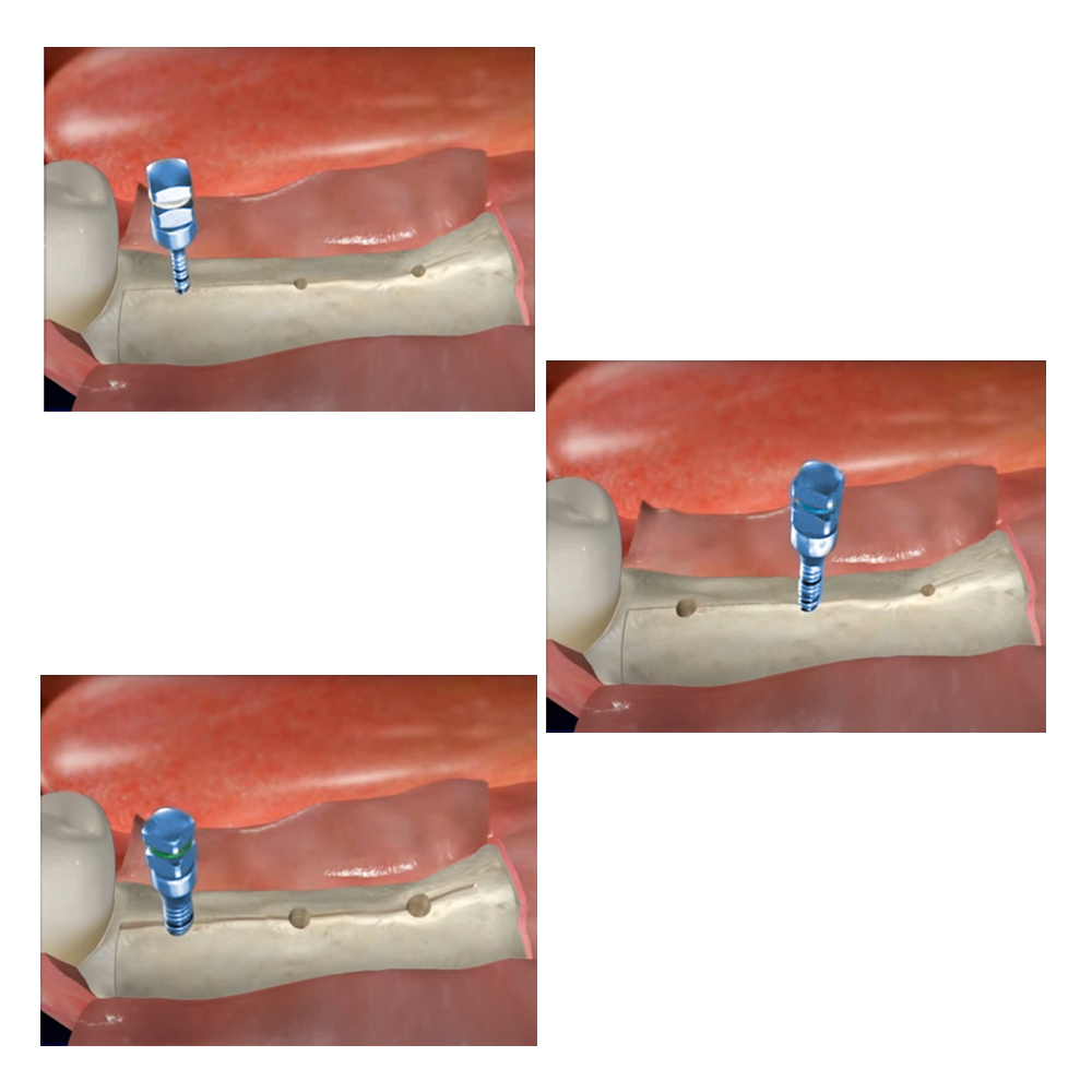 Julldent Bone Expansion Screws Set Refills 
