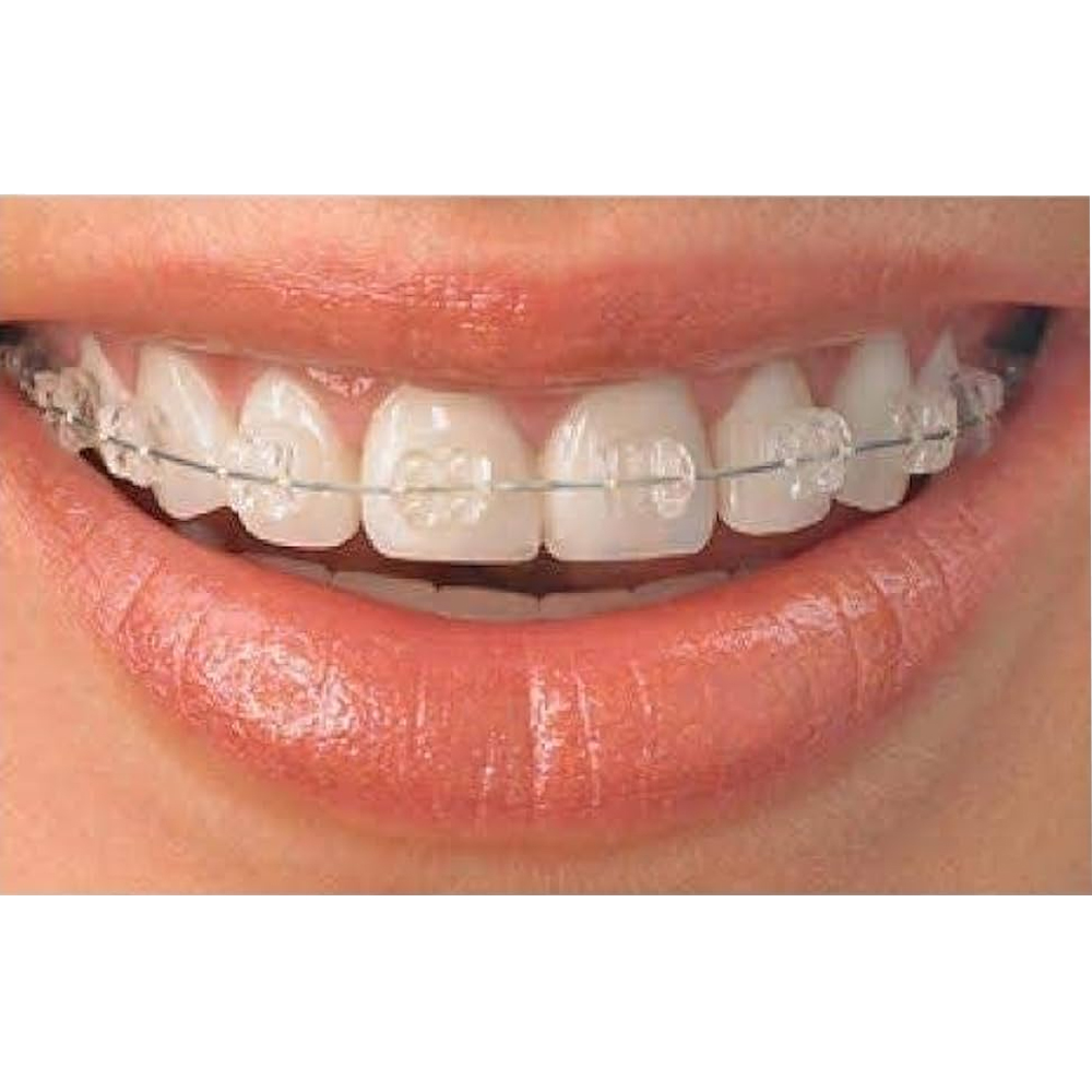 Koden Basic MBT Ceramic Bracket Kits