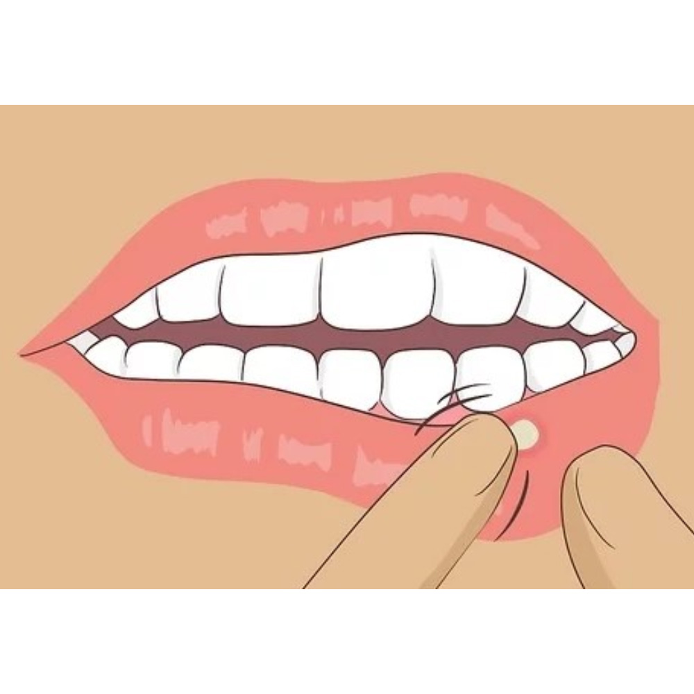 Abbott Kenacort 0.1% Oral Paste (Pack Of 25)