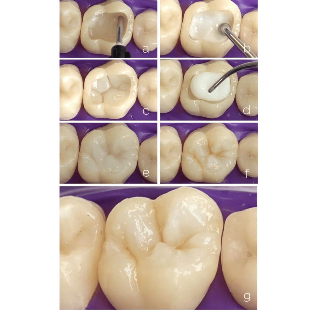 Kids-e-Restore Self Adhesive Flowable GIC