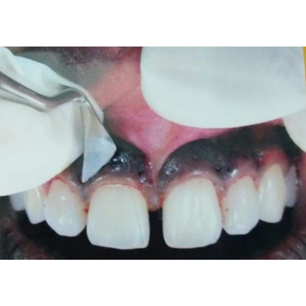 GDC Kirkland Knife #6 (Kk15/16)