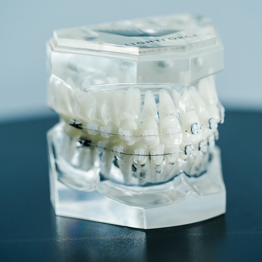 Koden Supreme MBT Ceramic Bracket Kits