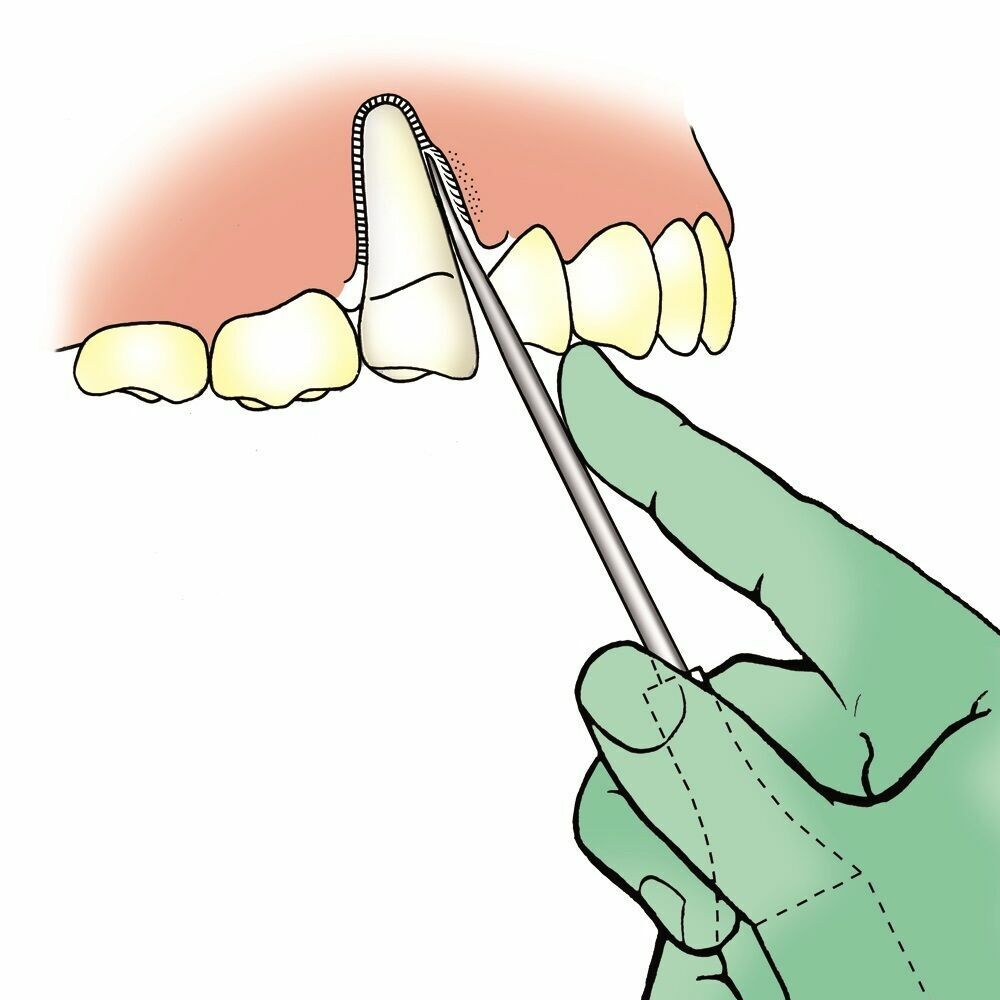 GDC Luxatip - 3mm Inverted Curved (L3ic)