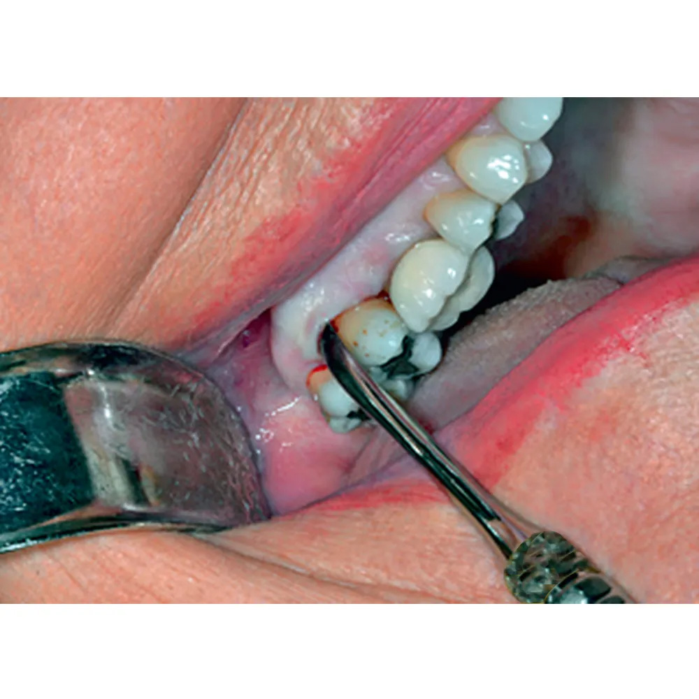 GDC Periosteal Elevator Labanca #6 (Pplabanca2)