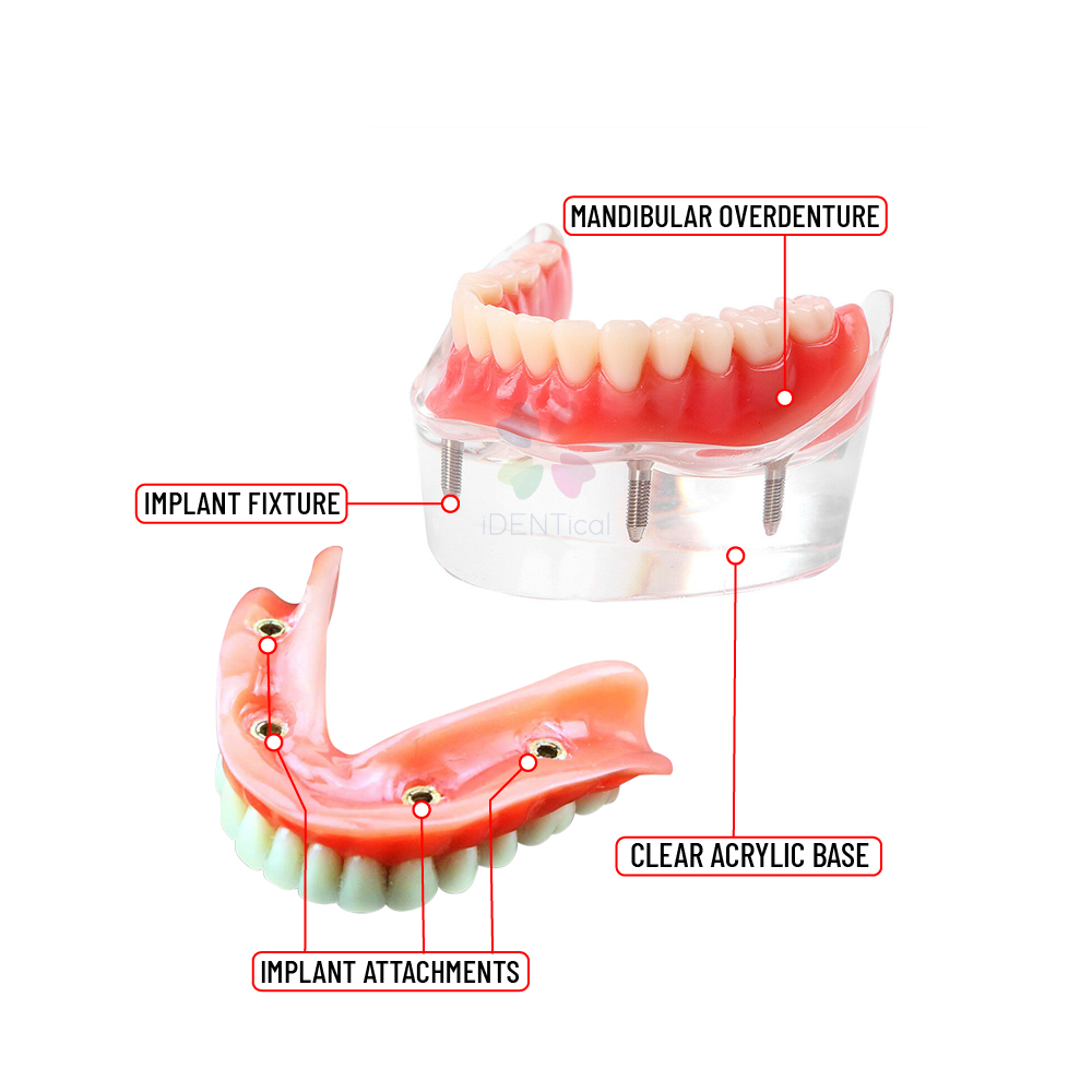 iDENTical Mandibular Overdenture Model with 4 Implants M6003