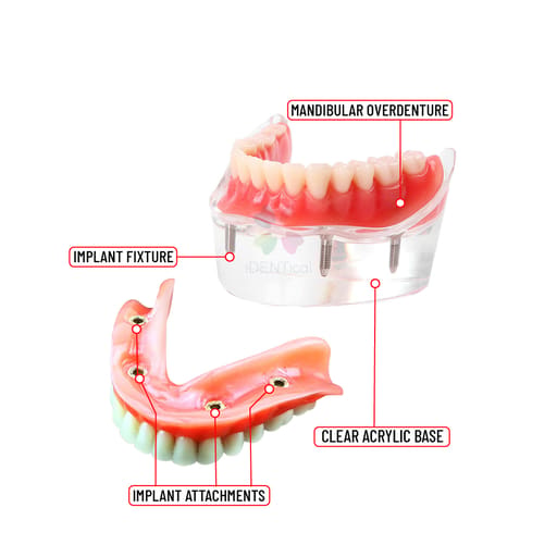 iDENTical Mandibular Overdenture Model with 4 Implants M6003