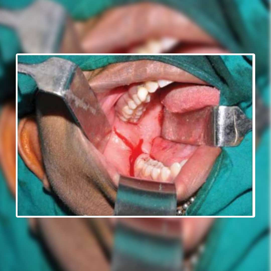 GDC Cheek Retractor Langenbeck - 40x13 (21.5cm) (CRL3)