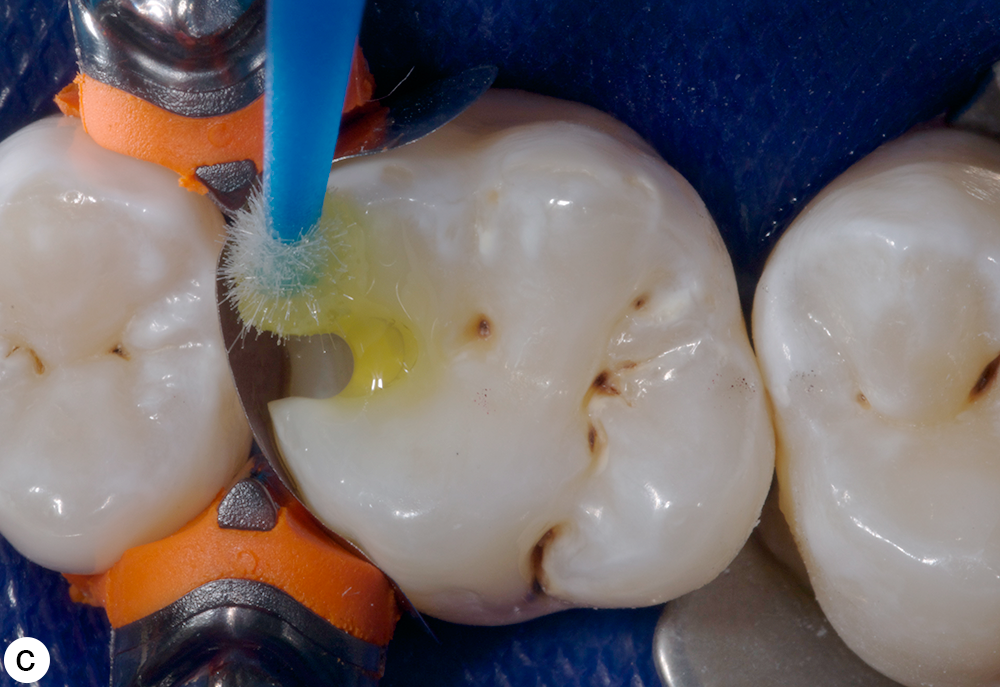 Coltene One Coat Bond SL