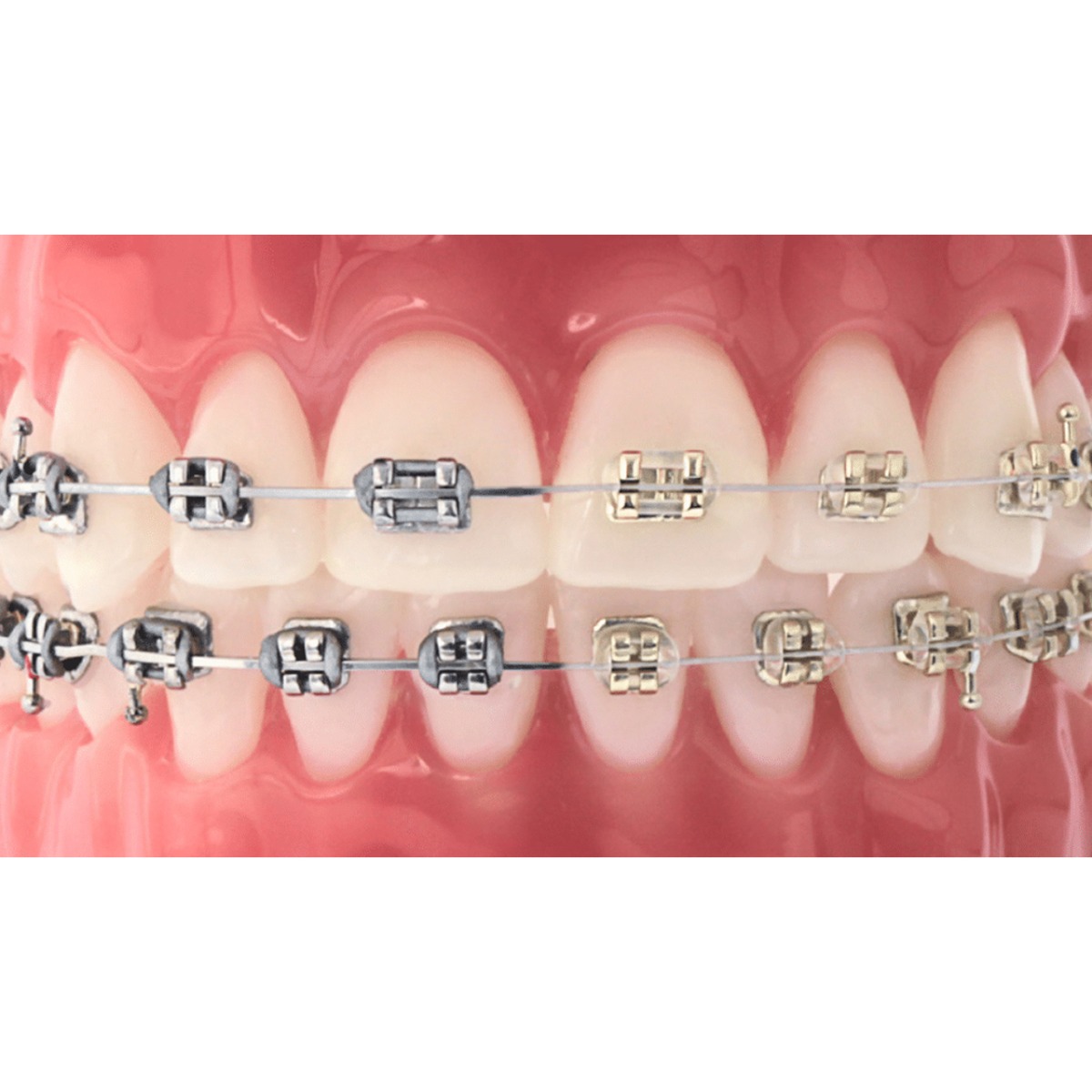 U ortho ligature Ties