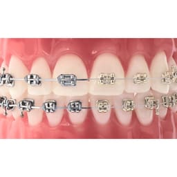 U ortho ligature Ties - 5