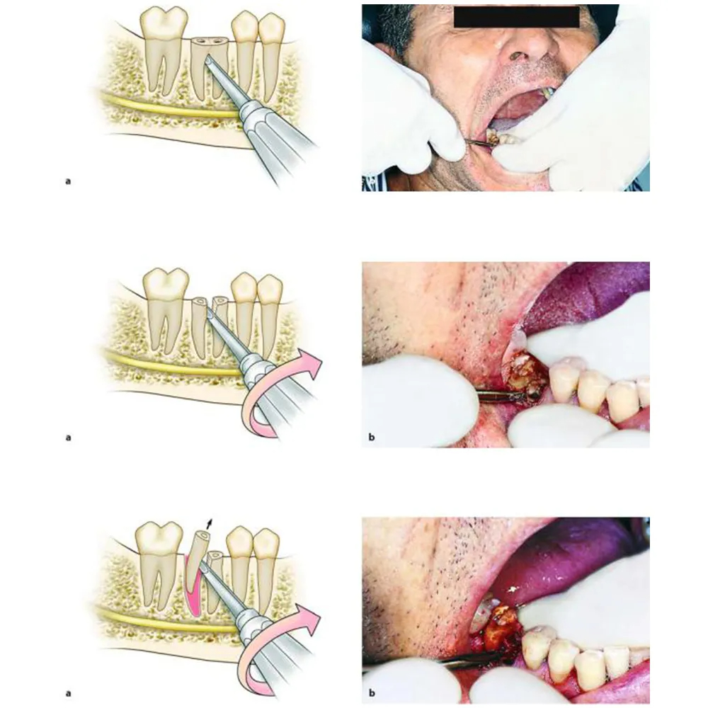 GDC Root Elevators Lindo Levian Straight - (3x8mm) Standard (Llm2)