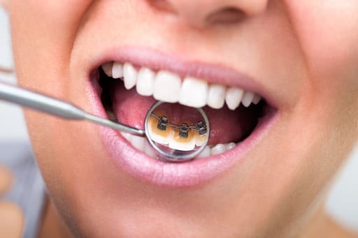 U Ortho Lingual Brackets 018