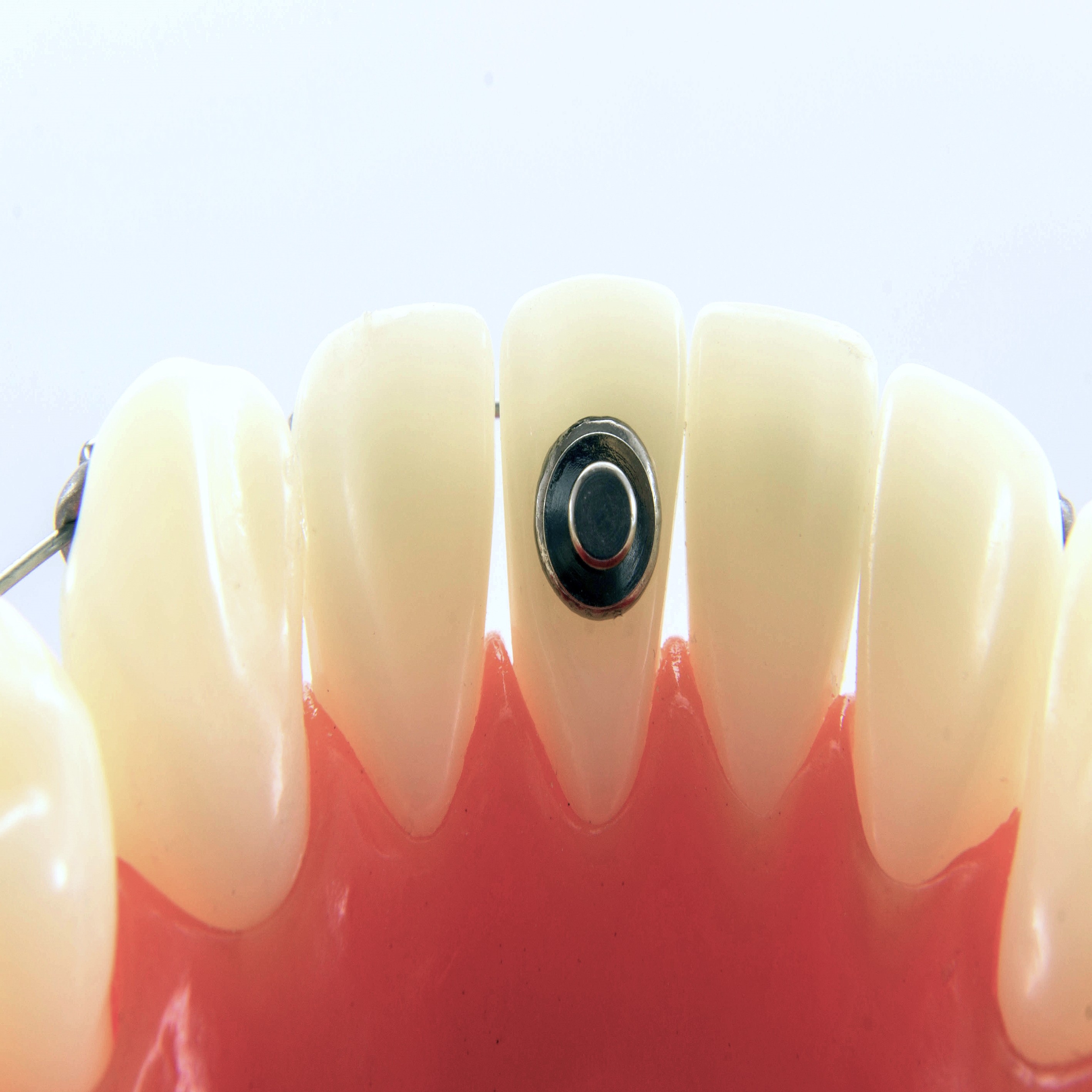 U Ortho Bondable Lingual Buttons Round (10/pk)