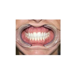 ET Dental Cheek Retractor Y Type-Small - 7