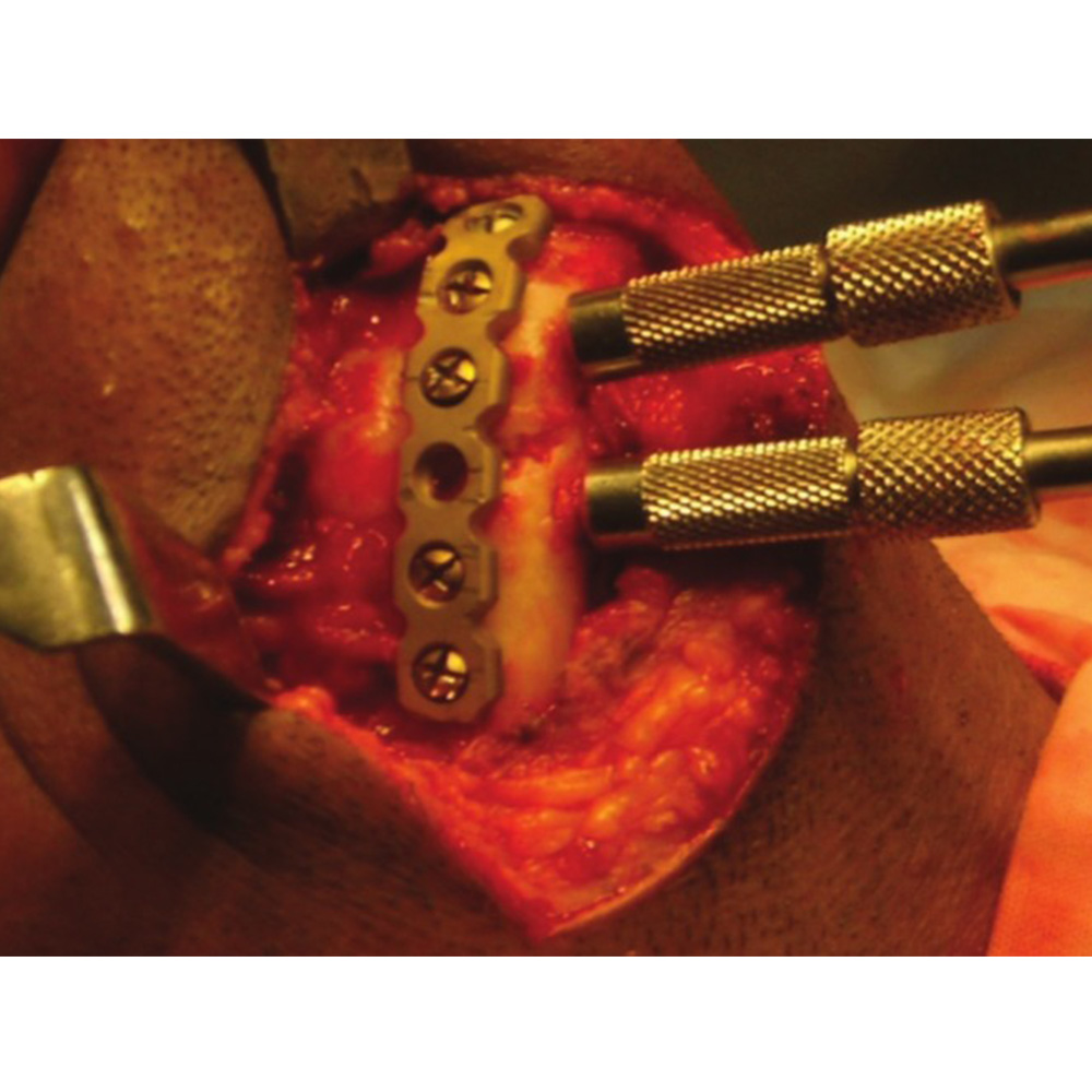 SK Surgicals Titanium Mini Bone Locking Plates - 2mm