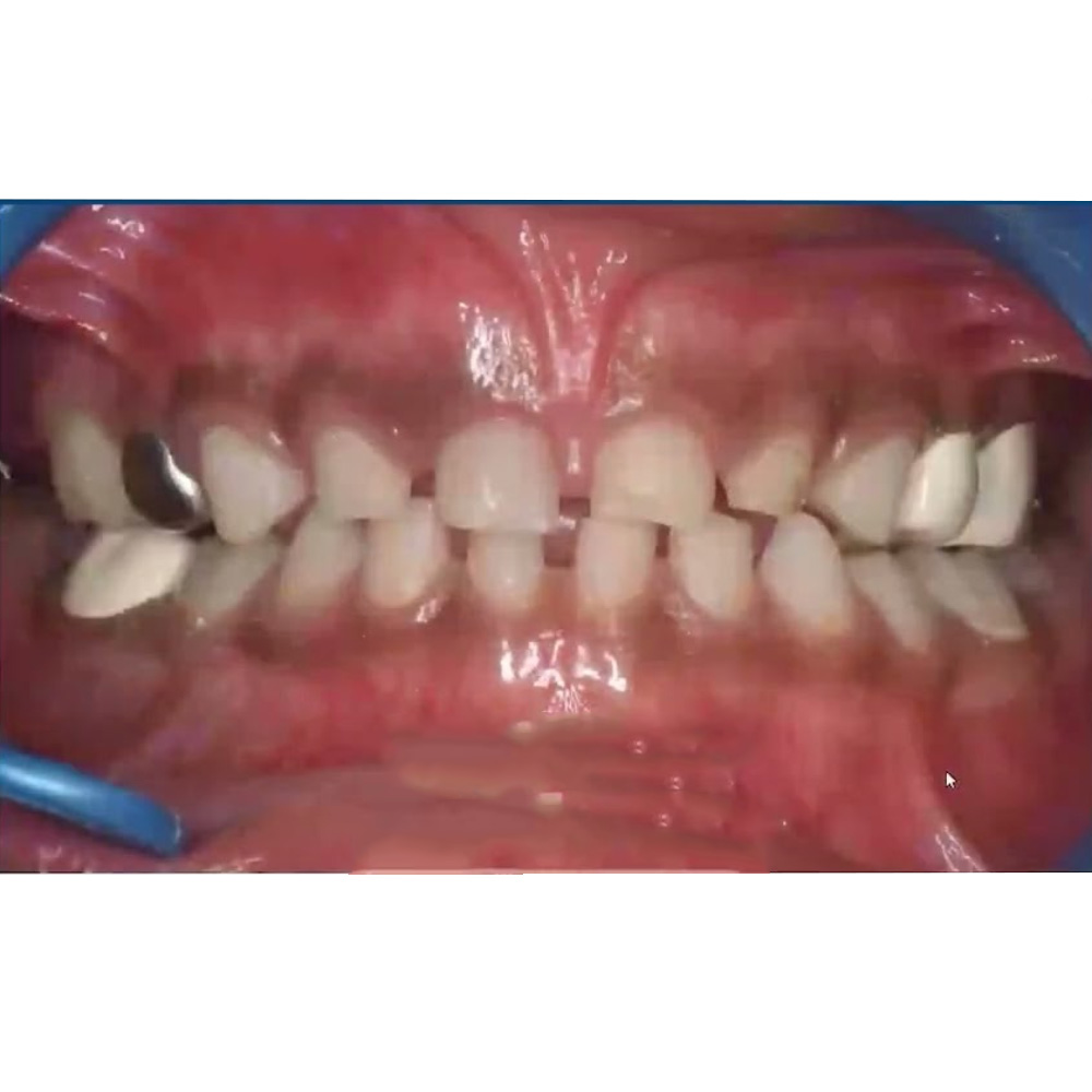 Kids-e-Dental BioFlx Lower Right 1st Molar Crowns Refills