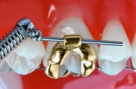 3m Unitek Forsus Fatigue Resistant Device L-Pin Module