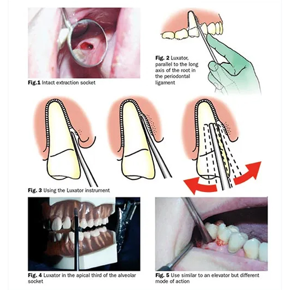 GDC Luxatip - 2mm Straight (L2s)