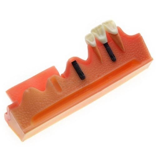 iDENTical Steps for Implant Model M2018