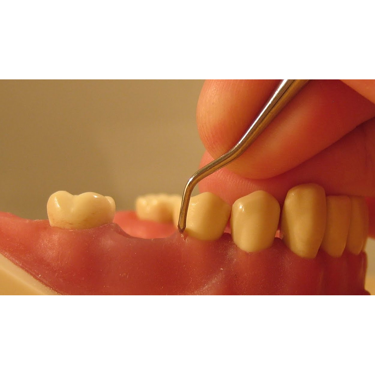 American Eagle Posterior Scaler 204S Talon Yellow Resin Handle with XP Technology - AES204SXPX