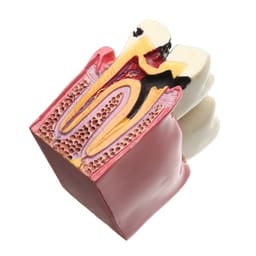 iDENTical Caries V/S Healthy Teeth Model M4021 - 5