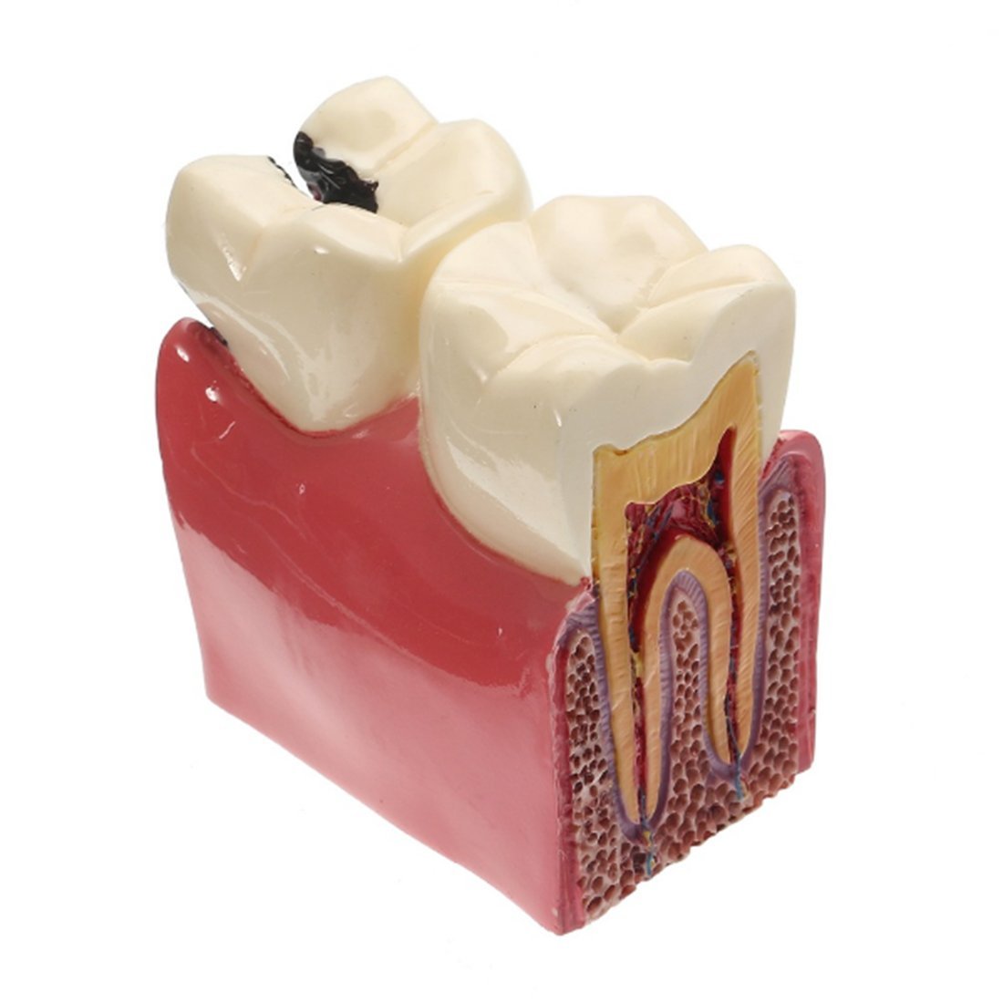 iDENTical Caries V/S Healthy Teeth Model M4021