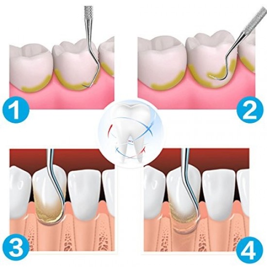 GDC Manipal Scaler Set Of 3 Pcs Instruments Kit (MS3)