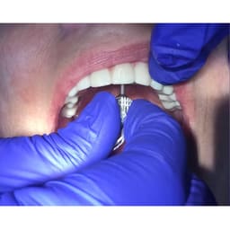 Nextin Dental Implant Prosthetic Hex Drivers - 5