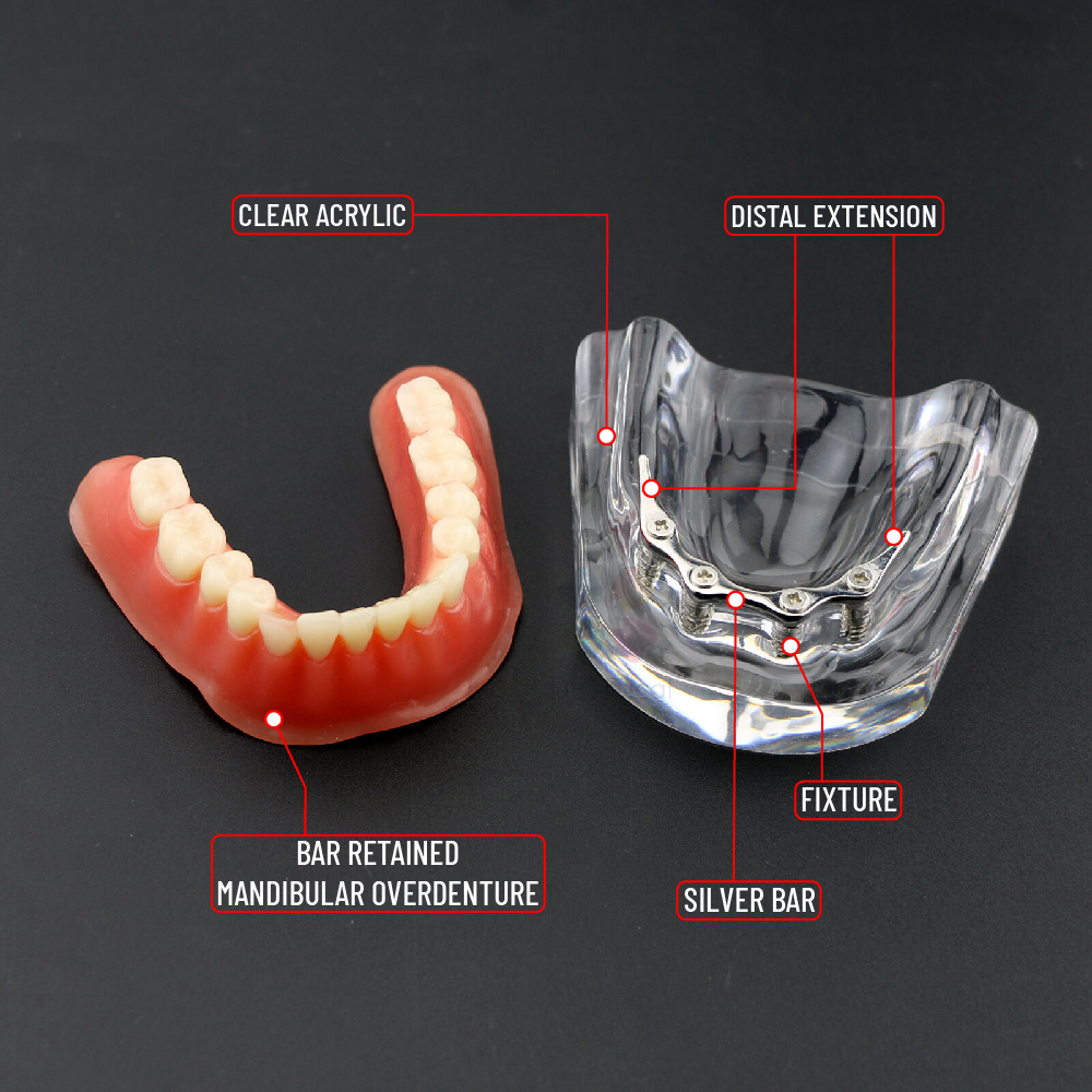 iDENTical Implant Model With Silver Bar M6008