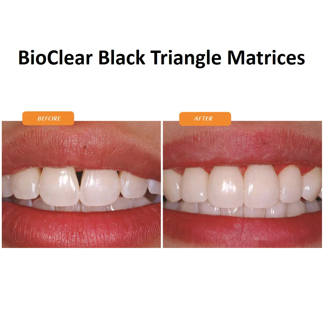 Bioclear Black Triangle Anterior Matrices - Refills Pack of 20