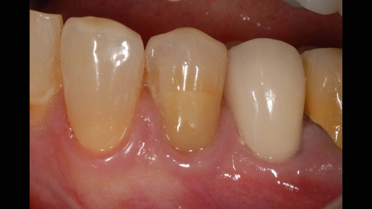 D-Tech Iono-Set Universal GIC Liquid