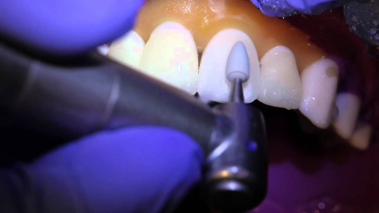 ET Dental Composite Finishing & Polishing Kit FG