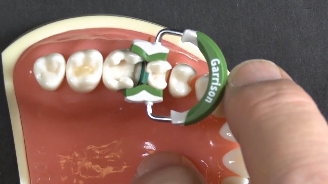 Garrison Dental Composi-Tight 3D Fusion Matrix Rings 