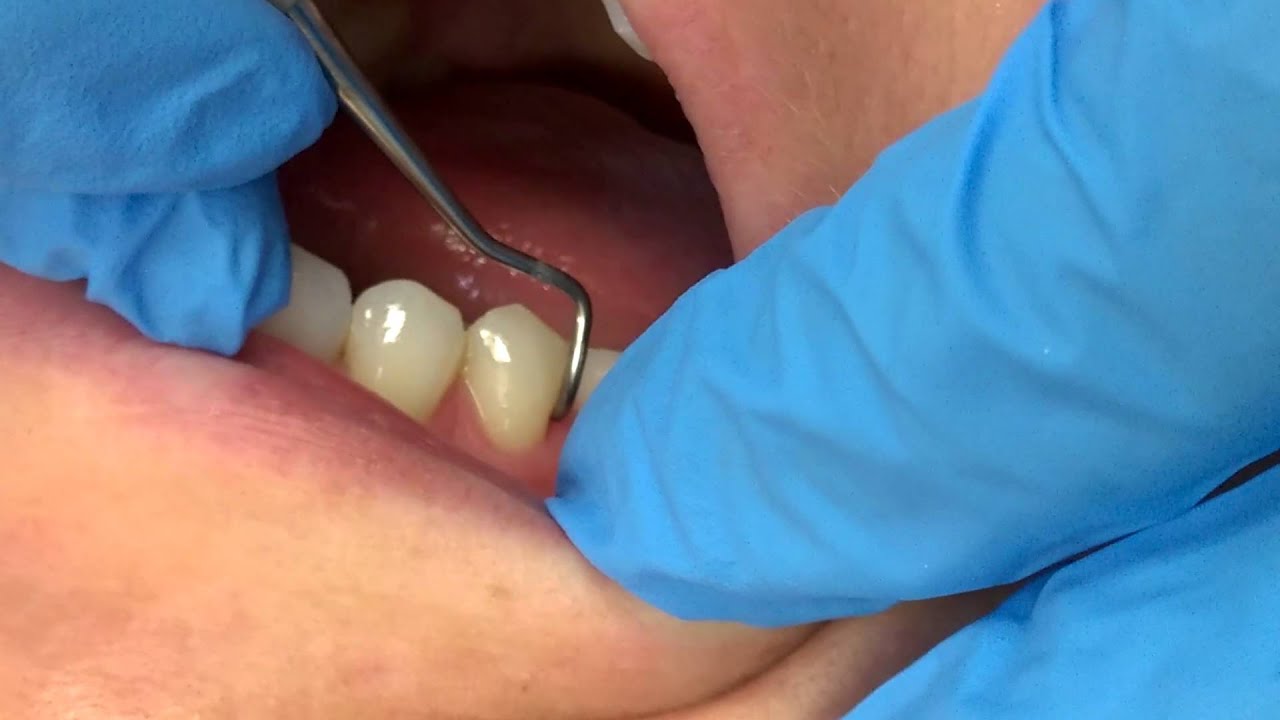 Gdc Conservative Kit Instruments Set Of 19 In Pouch (CIP19)