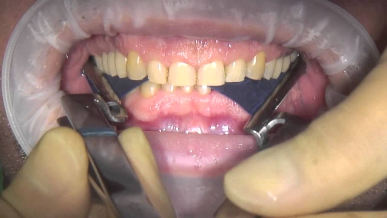 SuperEndo Dental Articulating Paper 100um Blue (Pack of 240)