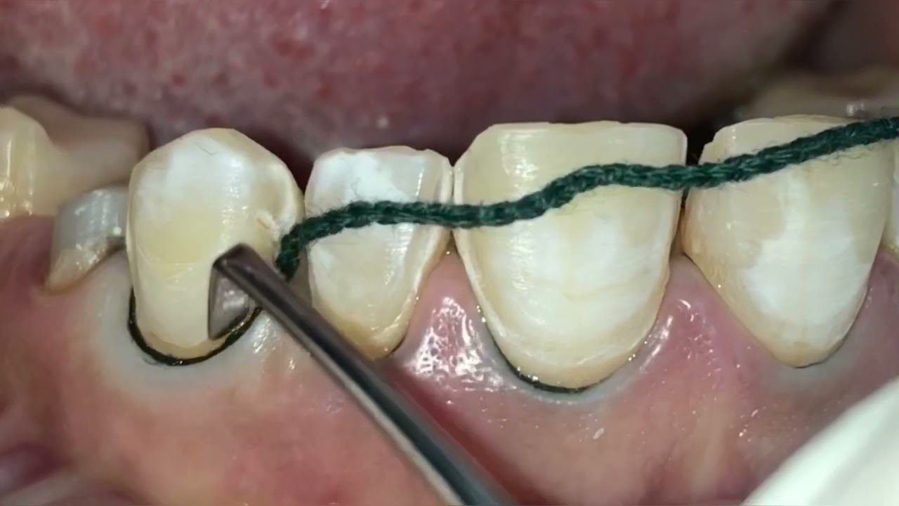 Sure Endo Sure Cord Knitted Retraction Cord