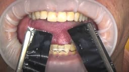 Bausch Dental Arti Fol Metallic Shimstock Flim 12µ Microns - 9
