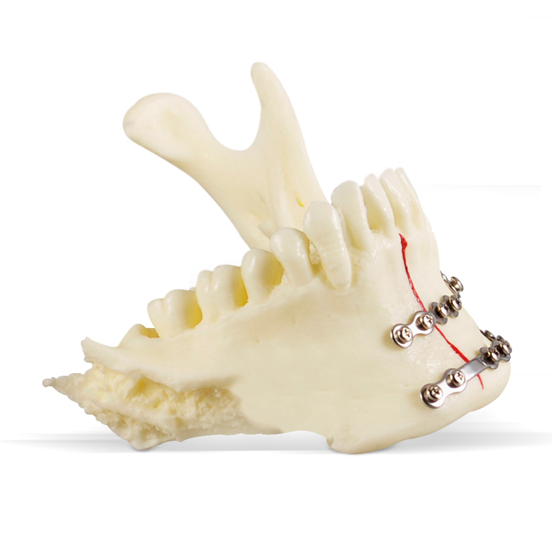 iDENTical Jaw with Titanium Plate Model M5001   