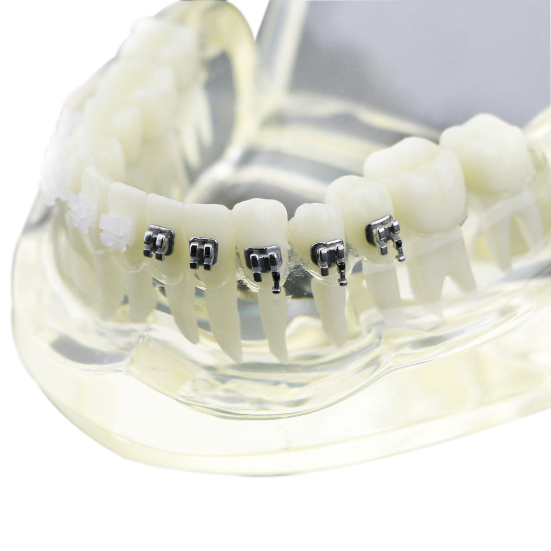 iDENTical Half Metal and Half Ceramic Brackets Orthodontic Models M3003