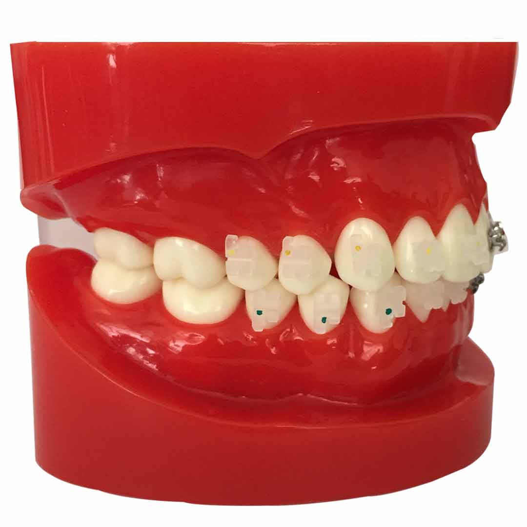 iDENTical Half Metal and Half Ceramic Brackets Orthodontic Models M3003