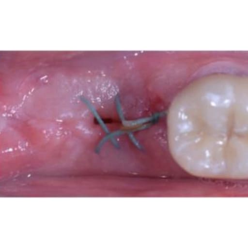 Meril Mericron XL #4-0 Polyester Suture