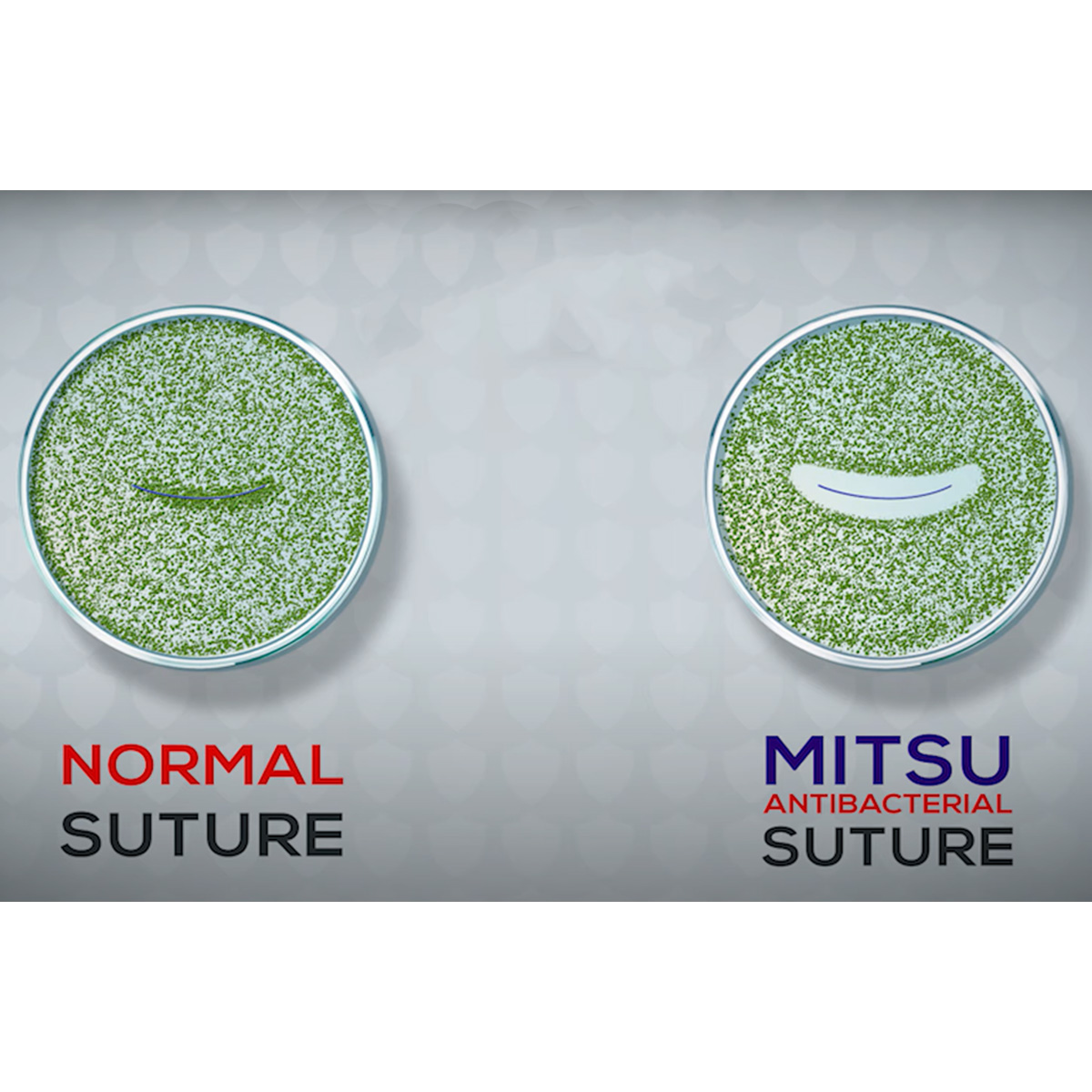 Meril Mitsu AB #2-0 Polyglactin 910 Suture With Triclosan